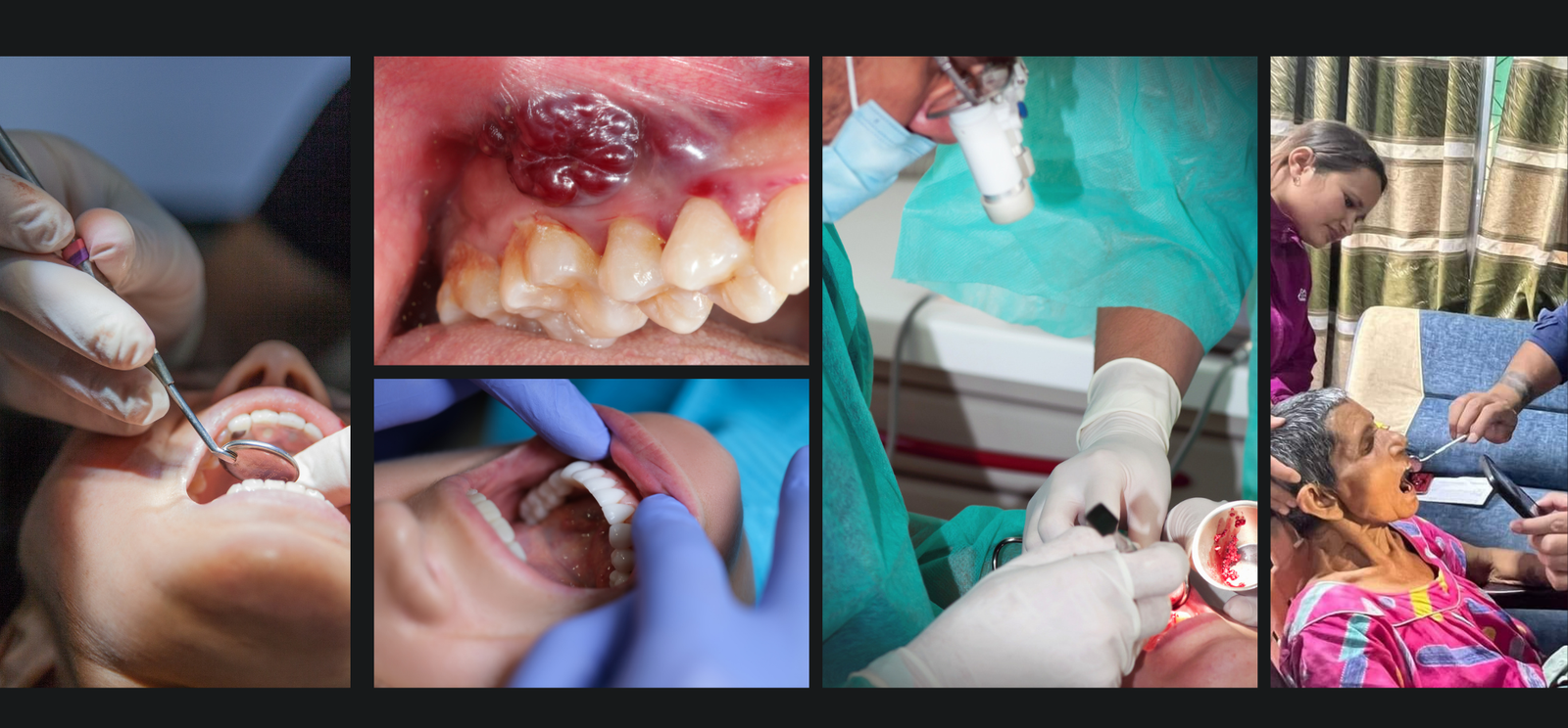 How Early Oral Cancer Screenings Can Save Lives